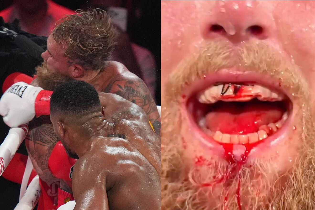 Jake Paul shows the brutal damage Anthony Joshua did to his jaw