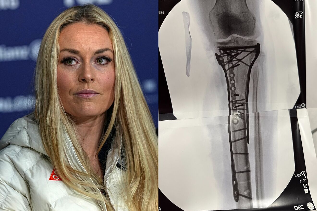 NFL injury expert warns of grim outlook after Lindsey Vonn's Olympic...
